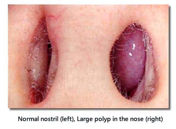 Normal nostril - left | Large polyp in the nose - right