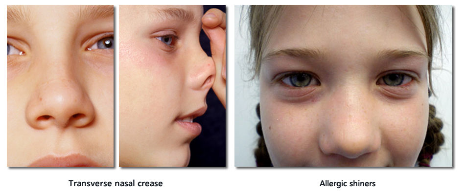 Transverse Nasal Crease and allergic shiners