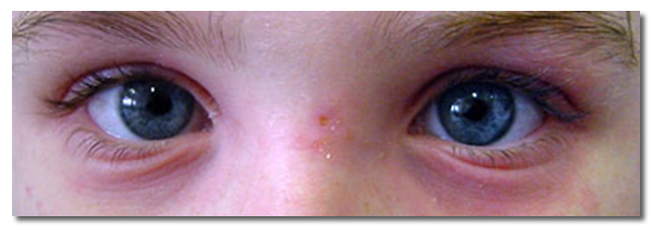 eyes of person with allergy